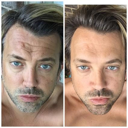 botox_kirisiklik