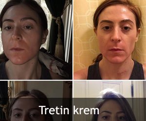 Azelderm Krem Kullandım Yorumlar ve Faydaları 5