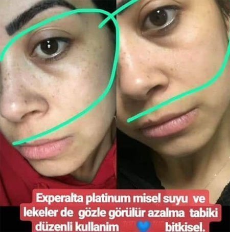 yuz_beyazlatma_01