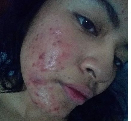 Acnegen Nedir? Yan Etkileri 2 Acnegen Nedir? Yan Etkileri 1