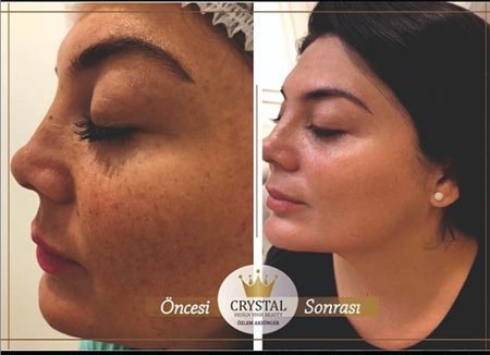Yüzdeki Koyu Lekeler için Maske tarifleri 1