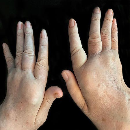 İltihaplı Romatizma Belirtileri Nelerdir? 1