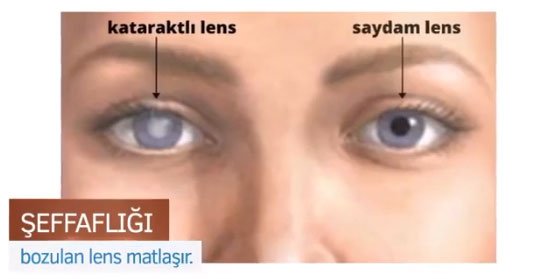 Retina Dekolmanının Nedenleri Nelerdir? 2 Retina Dekolmanının Nedenleri Nelerdir? 2