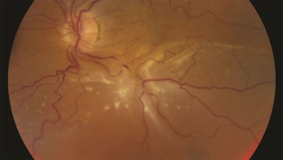 Retina Dekolmanının Nedenleri Nelerdir? 1 Retina Dekolmanının Nedenleri Nelerdir? 1